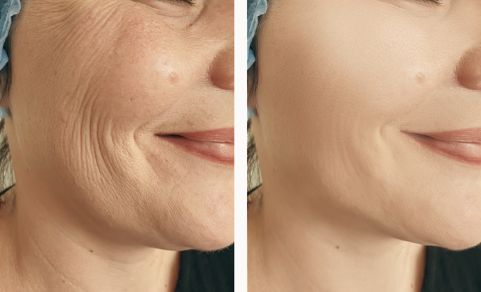 Lifting Facial 1