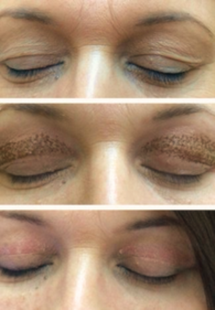 Lifting Facial 2